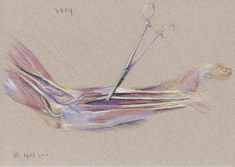 Forearm (left, medial view): Forceps Gripping Flexor Tendons by Susan Dorothea White
